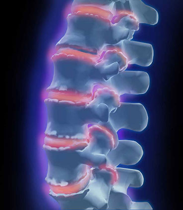 Celebrex Patient Consultation Aid Spinal disease, osteoarthritis, with osteophyte formation, joint space narrowing, and narrowingof foramina. 